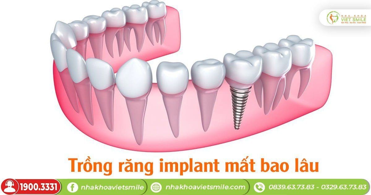 Trồng răng implant mất bao lâu