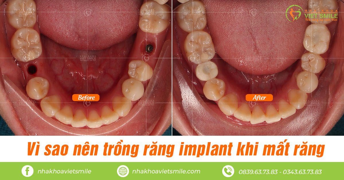 Cấy răng implant an toàn tại việt smile