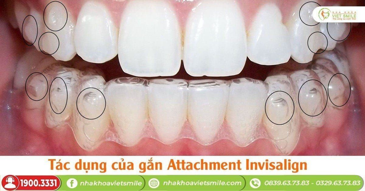 Gắn attachment lên răng