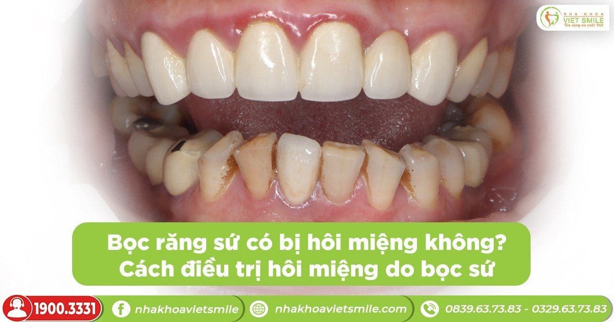 Bọc răng sứ có bị hôi miệng không? Cách điều trị hôi miệng do bọc sứ