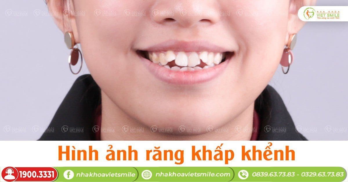 Răng khểnh gây mất thẩm mỹ thì nên niềng răng