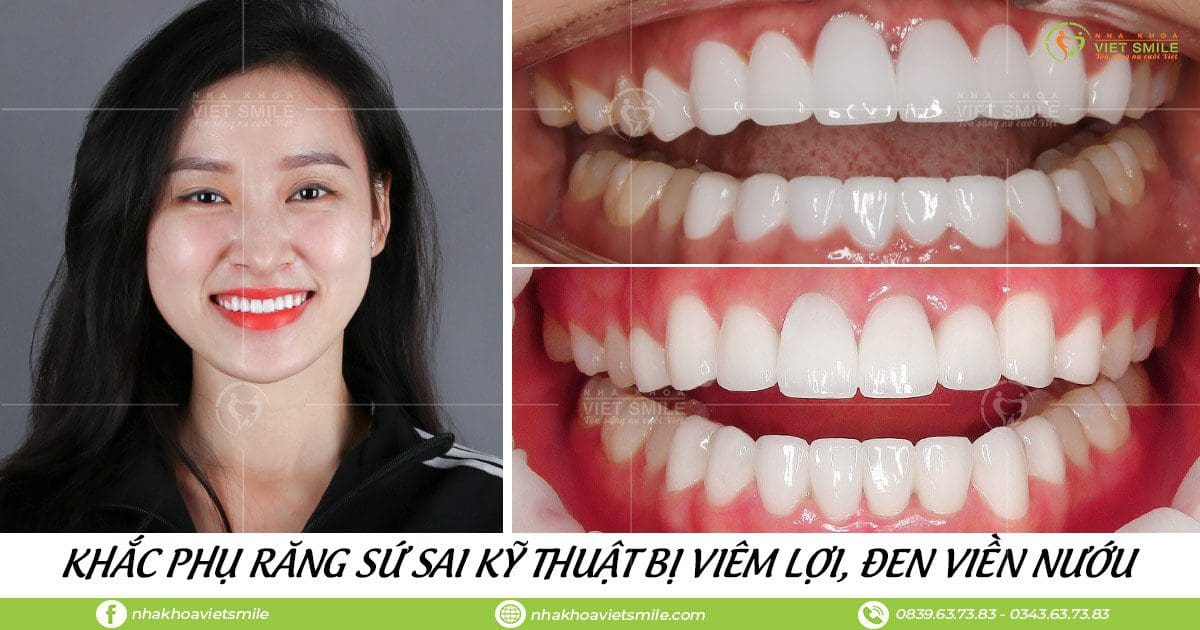 Bọc răng sứ viêm lợi
