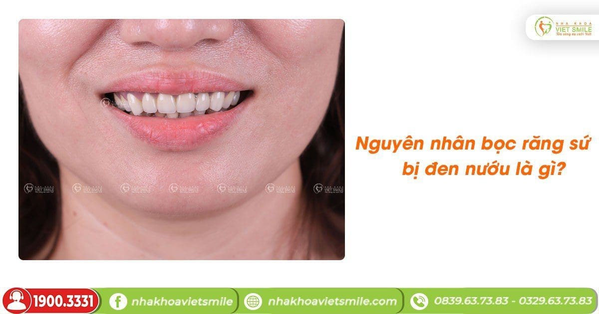 Nguyên nhân bọc răng sứ bị đen nướu là gì?
