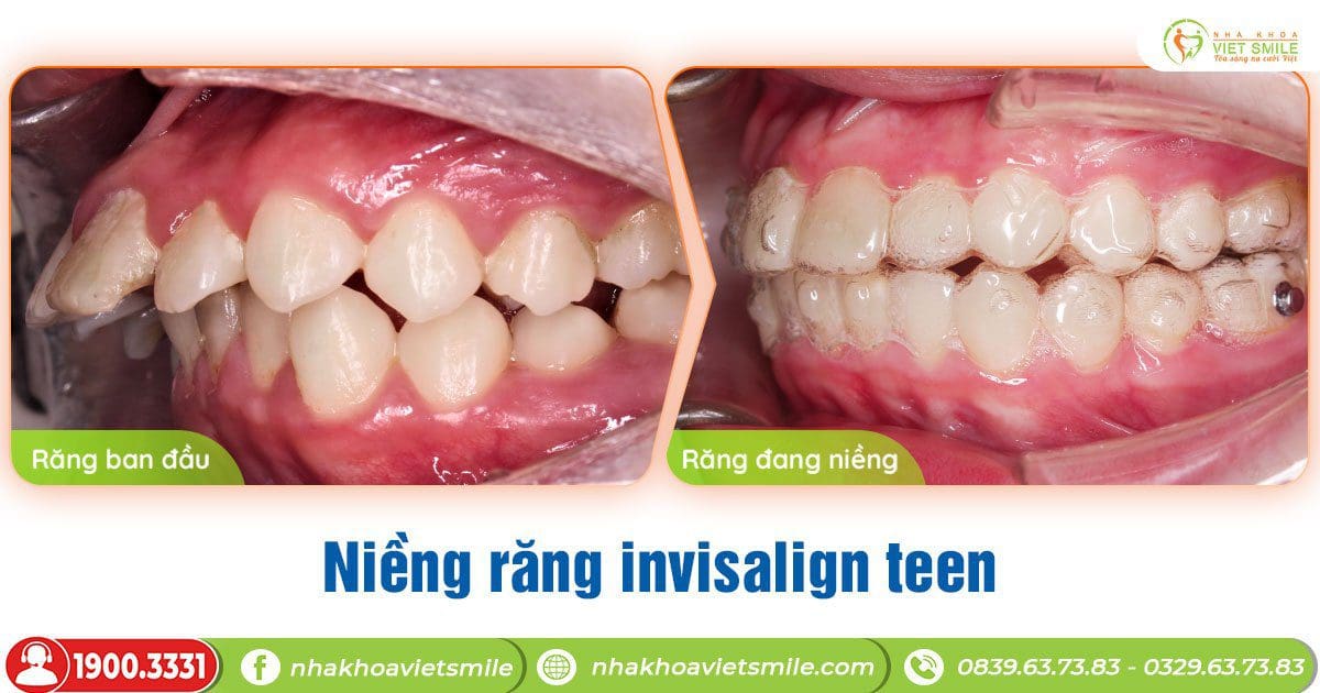 Niềng răng trong suốt invisalign teen