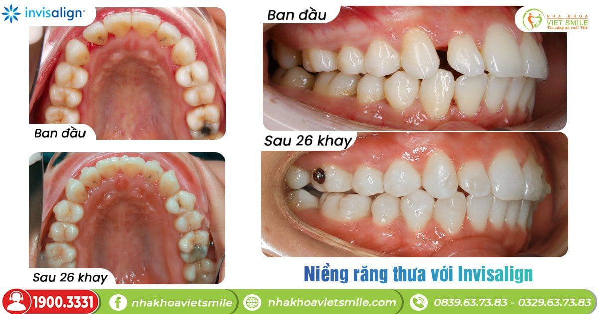 Hay niềng trong suốt invisalign
