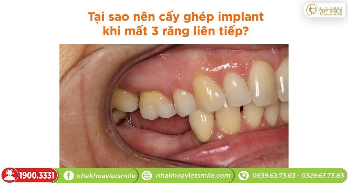Tại sao nên cấy ghép implant khi mất 3 răng liên tiếp