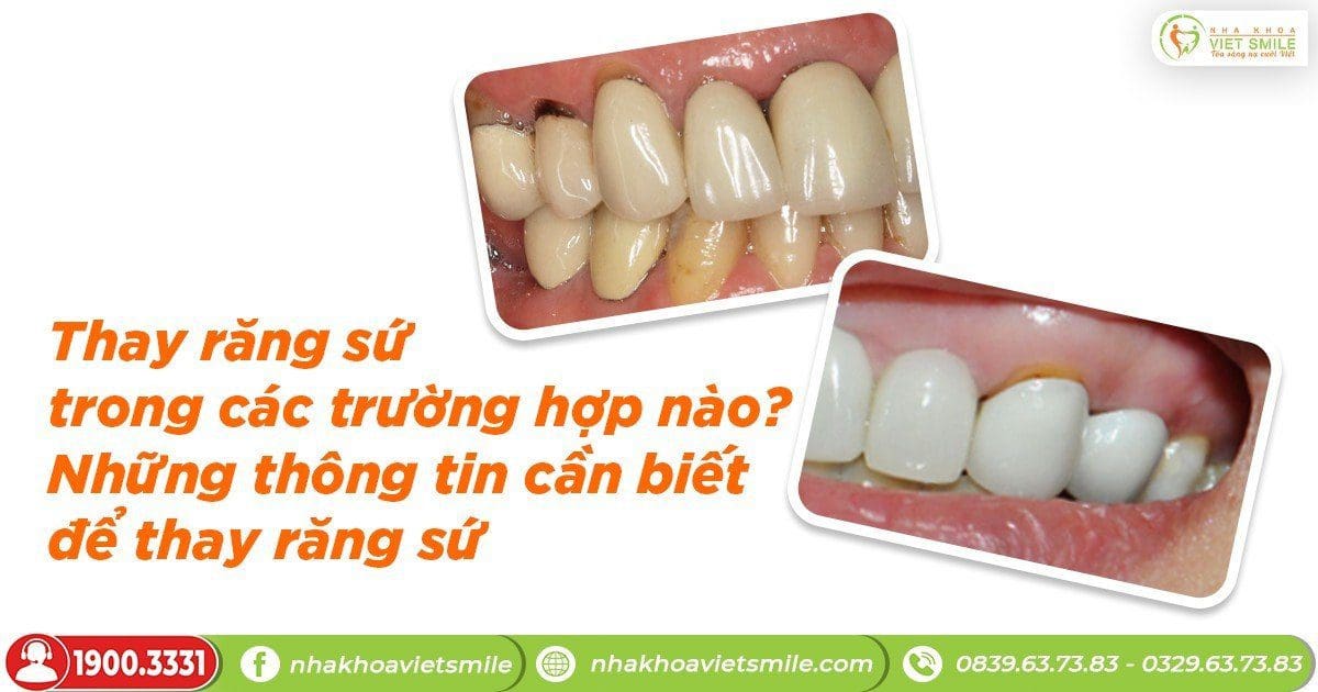 Thay răng sứ trong các trường hợp nào? Những thông tin cần biết để thay răng sứ