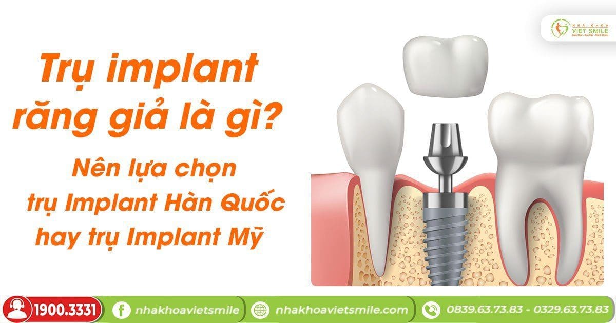 Trụ implant răng giả là gì? Nên lựa chọn trụ Implant Hàn Quốc hay trụ Implant Mỹ