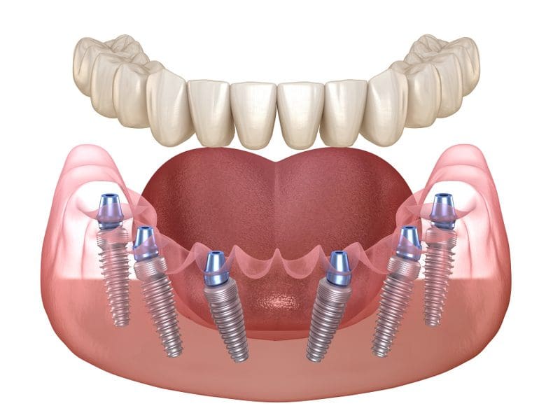 mất răng toàn hàm cấy ghép implant có tốt không? 5 Kỹ thuật cấy ghép implant all on 6