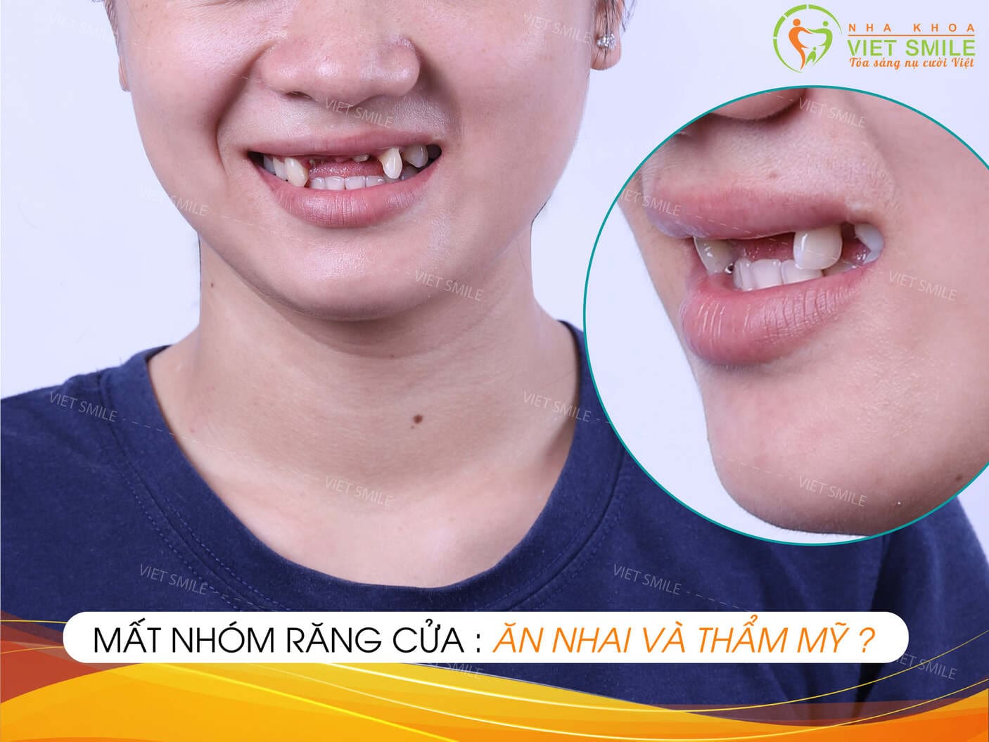 Mất răng cửa có trồng implant được không? 1 Mat rang cua co trong implant