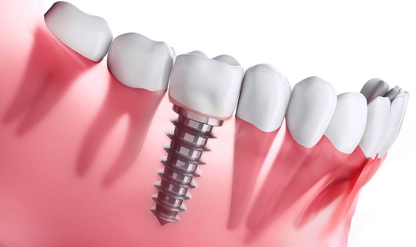 mất răng toàn hàm cấy ghép implant có tốt không? 1 Mat rang toan ham