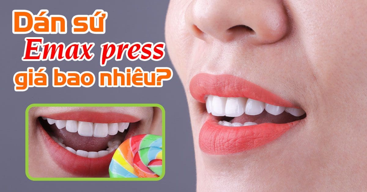 Răng sứ emax press bao nhiêu tien