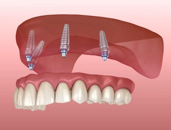 mất răng toàn hàm cấy ghép implant có tốt không? 4 Cấy ghép implant all on 4