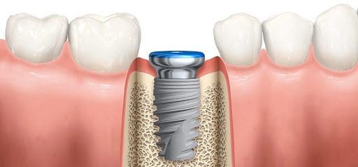 mất bao lâu để hoàn thành 1 ca cấy implant? 2 Dat tru implant