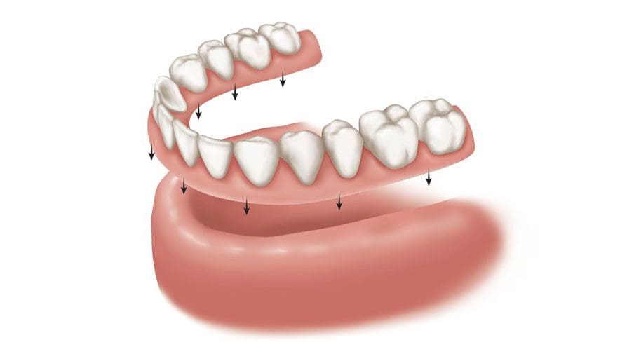 mất răng toàn hàm cấy ghép implant có tốt không? 3 Ham gia thao lap
