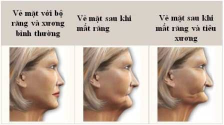 mất răng toàn hàm cấy ghép implant có tốt không? 2 Mat rang