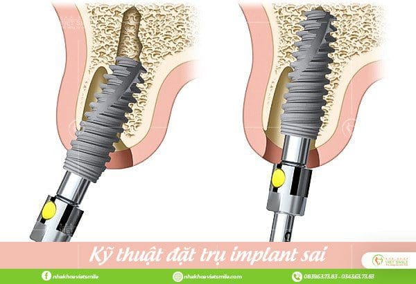 Tại sao răng implant bị đào thải sau khi cấy ghép? 5 Ky thuat dat tru implant