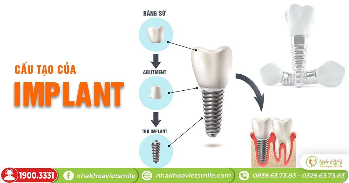 Những ai không nên cấy ghép implant? 3 Răng implant