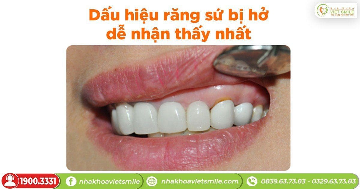 5 dấu hiệu răng sứ bị hở dễ nhận thấy nhất