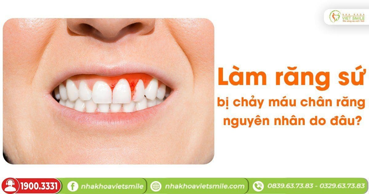 Làm răng sứ bị chảy máu chân răng nguyên nhân do đâu?