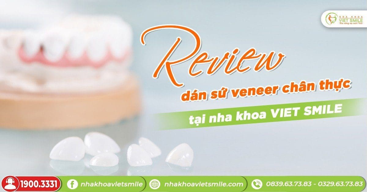 Review dán sứ veneer chân thực tại nha khoa Việt Smile