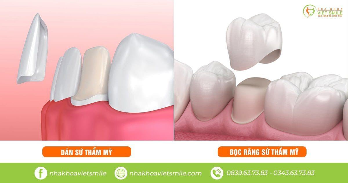 So sánh phương pháp bọc răng sứ và dán sứ veneer 1 Bọc răng sứ và dán sứ veneer