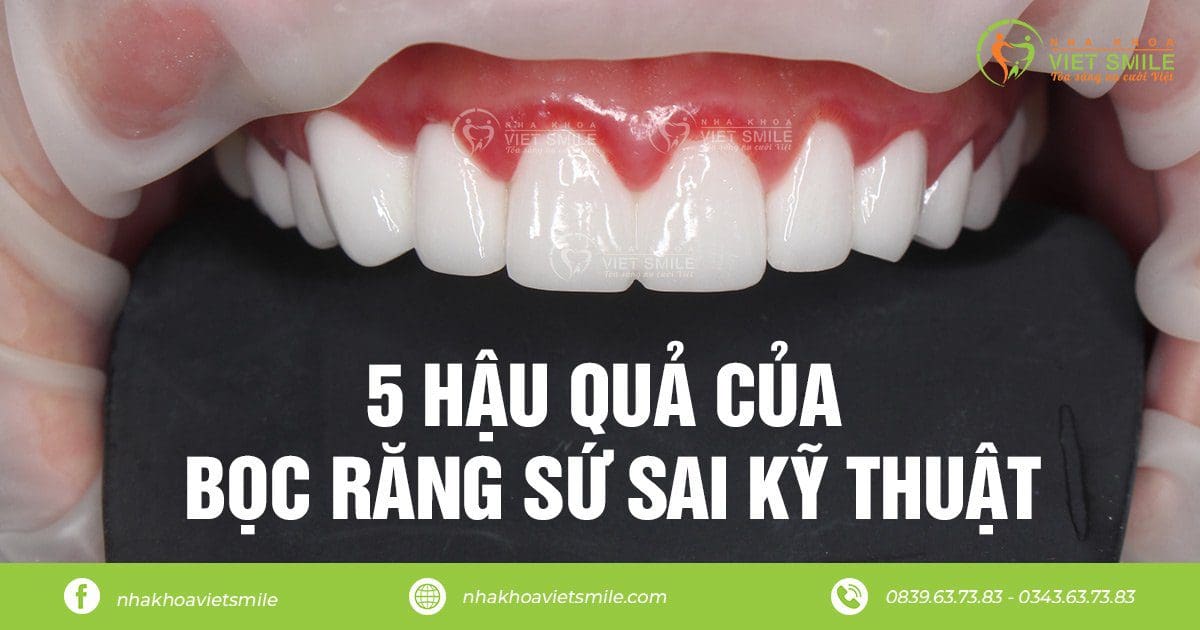 5 hậu quả của bọc răng sứ sai kỹ thuật