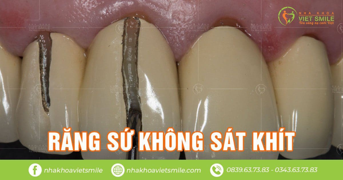 Tháo răng sứ có đau không? 4 Tháo răng sứ