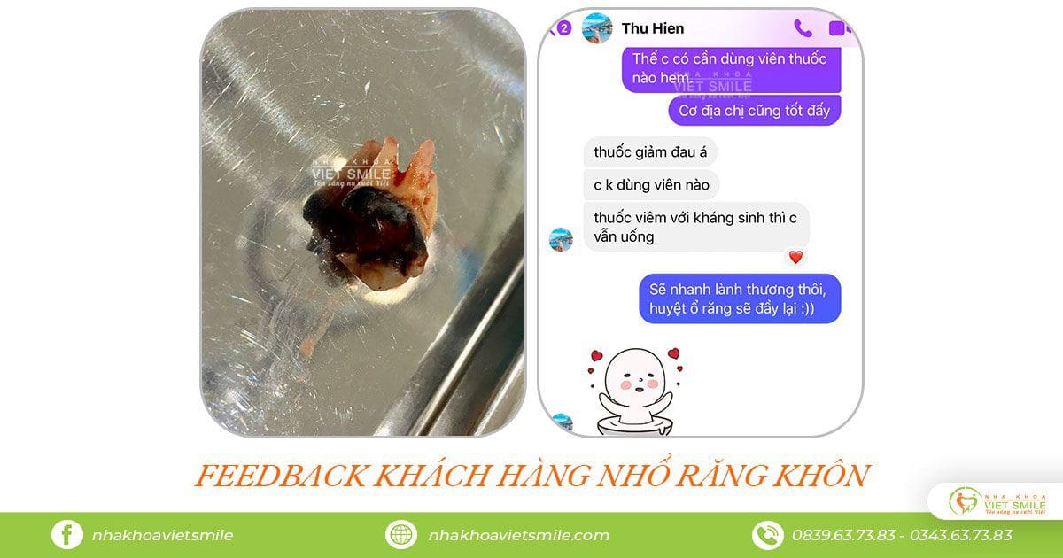 Nhổ răng khôn 15 Răng 8 sâu