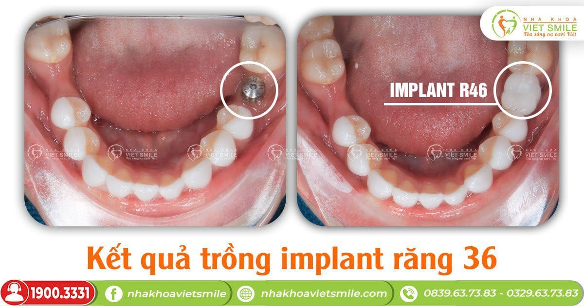 Kết quả phục hình implant răng số 6