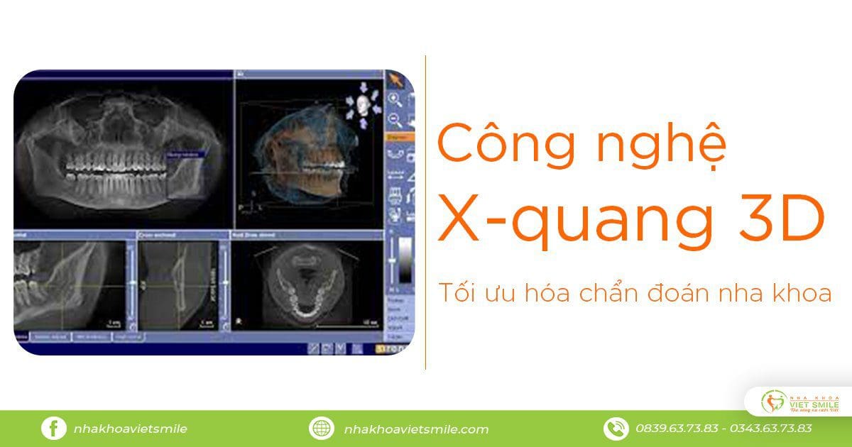 công nghệ xquang 3d tối ưu hóa chẩn đoán nha khoa 1 Công nghệ xquang 3d