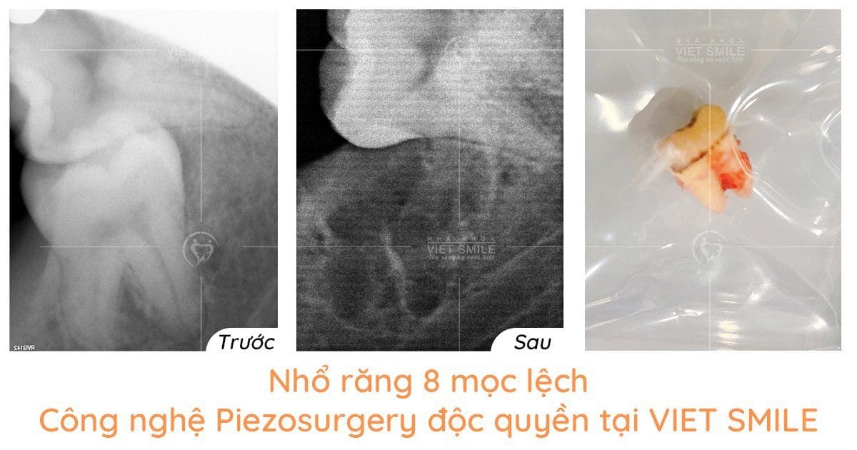 Loại bỏ răng 8 với piezosurgery