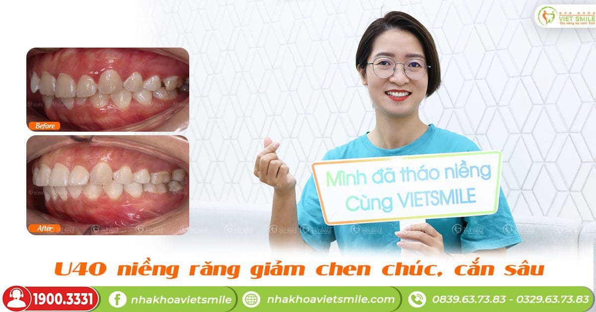 Chị Nguyễn Thị Phượng niềng răng tuổi U40