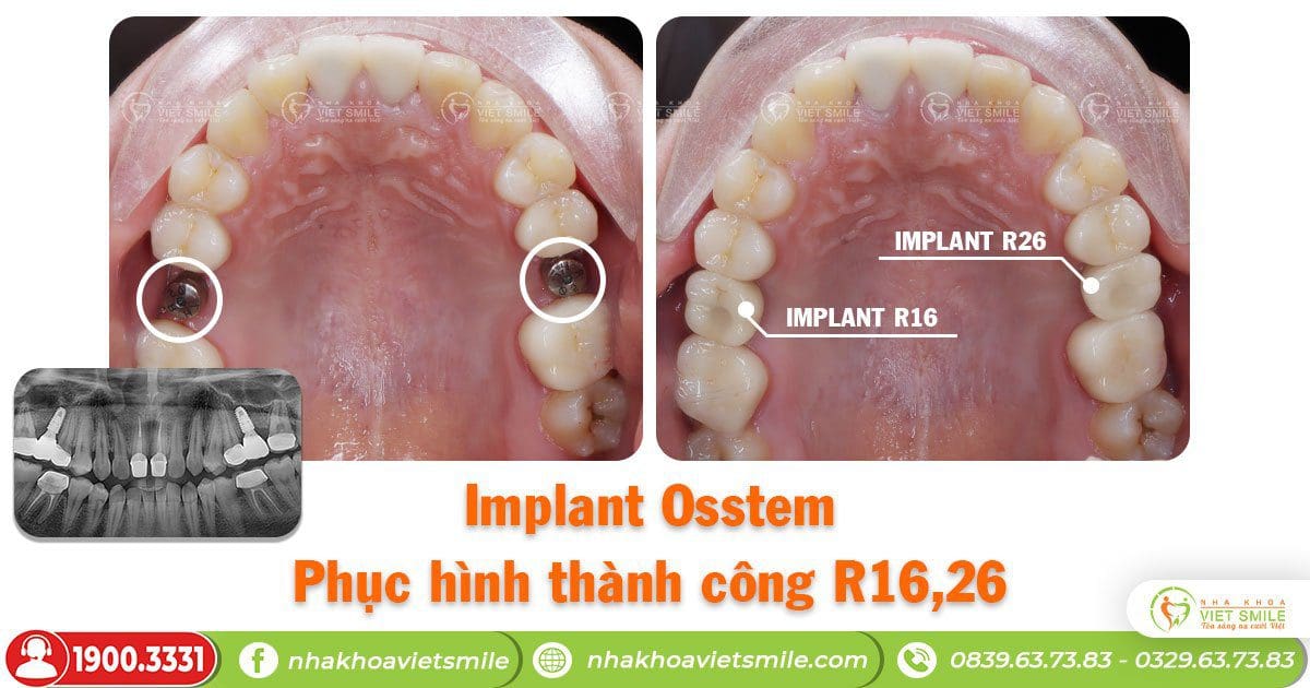 Răng số 6 implant