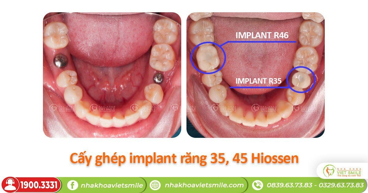 Kết quả trồng implant răng 46, răng 35