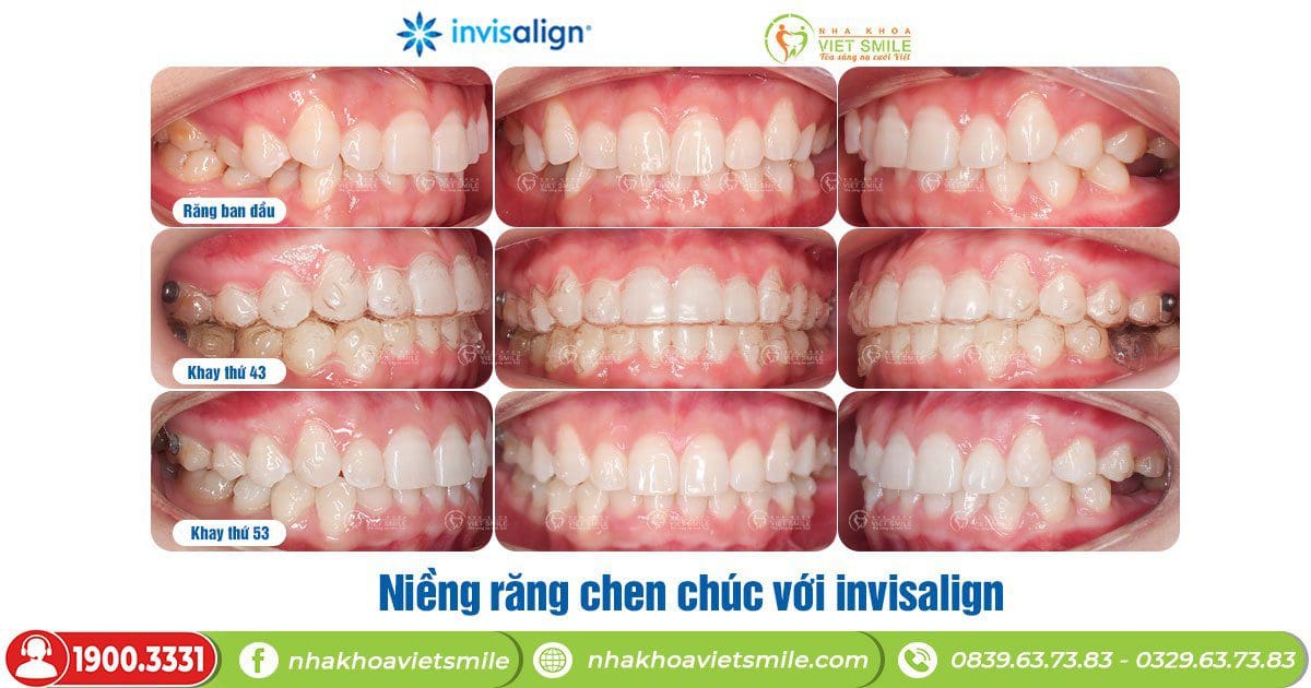 Răng chen chúc thay đổi cùng invisalign