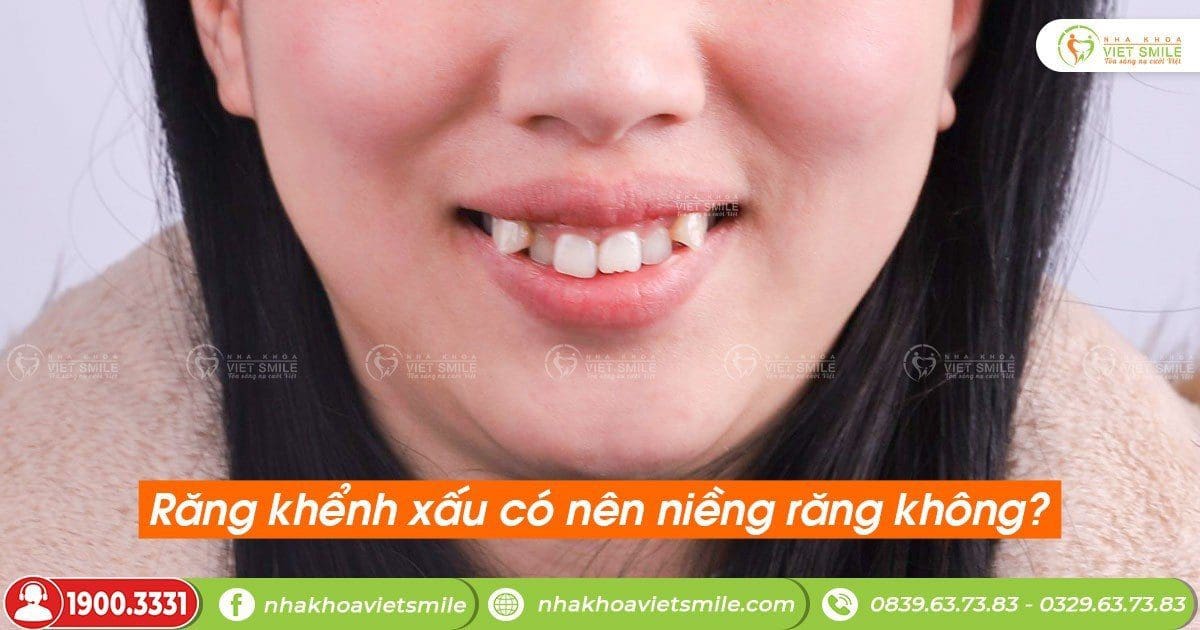 Răng khểnh xấu có nên niềng răng không?