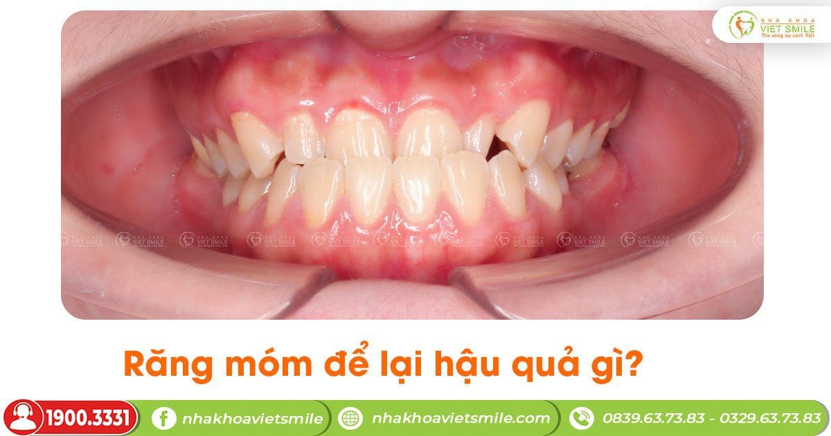 Răng móm để lại hậu quả gì?