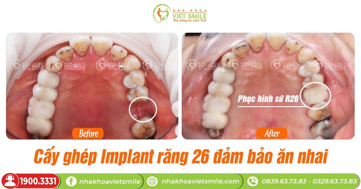 Kết quả trồng implant răng 26