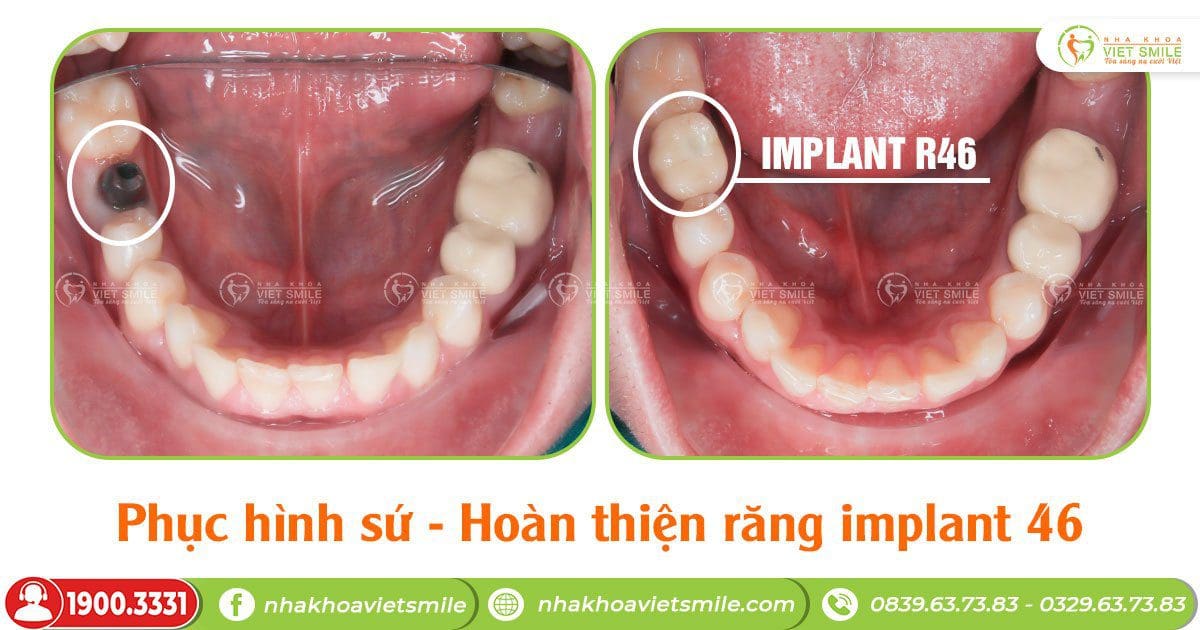 Phục hình răng sứ trên implant