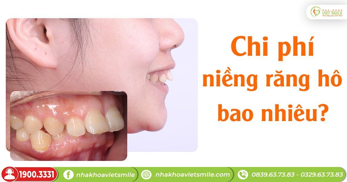 Chi phí niềng răng hô tại nha khoa việt smile bao nhiêu? 1 Chi phí niềng răng hô