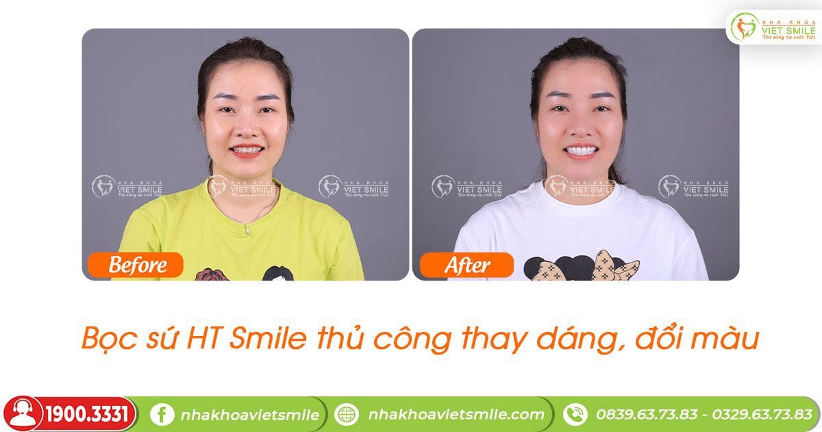 Hết ố vàng, cải thiện tình trạng răng ngắn với sứ ht smile thủ công
