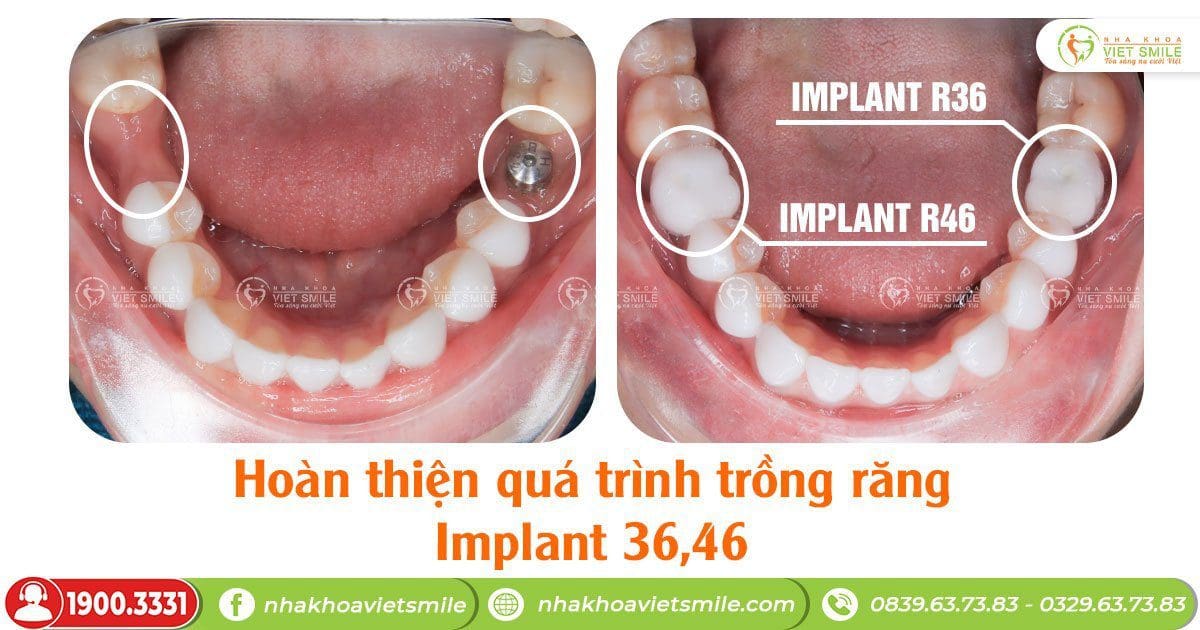 Hoàn thiện phục hình implant răng 46