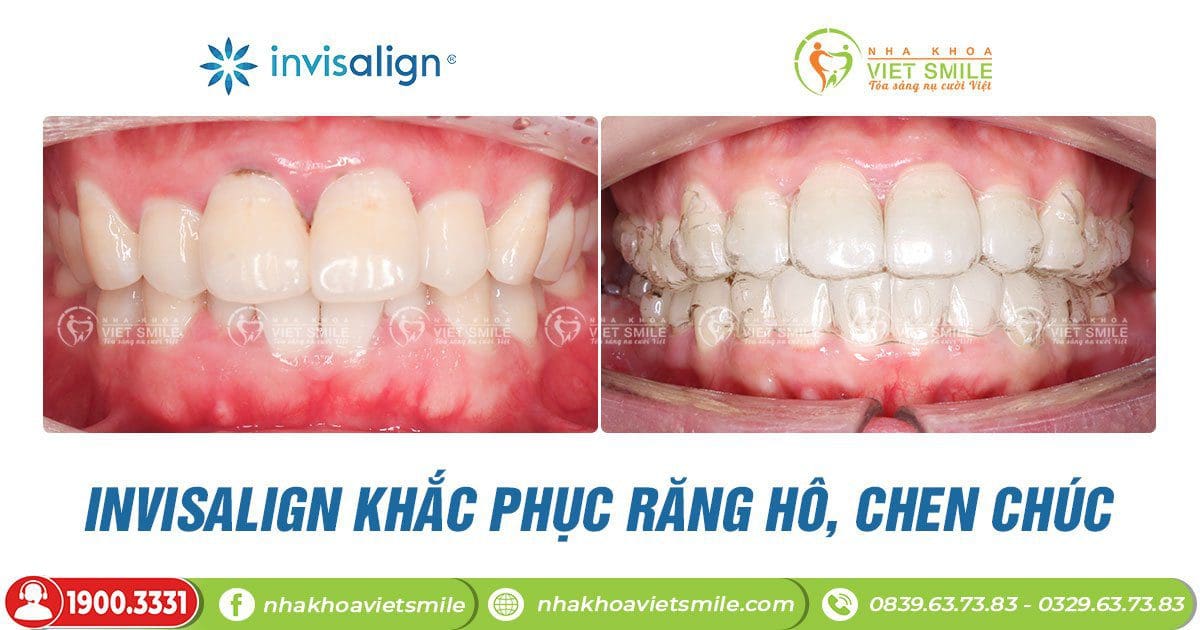 Tư vấn niềng răng invisalign bao nhiêu tiền? 9 Niềng invisalign khắc phục tăng hô, chen chúc