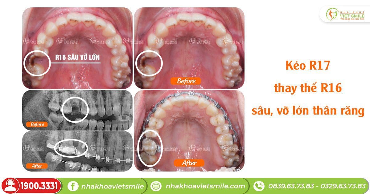 Kéo răng thay thế răng sâu vỡ thân răng