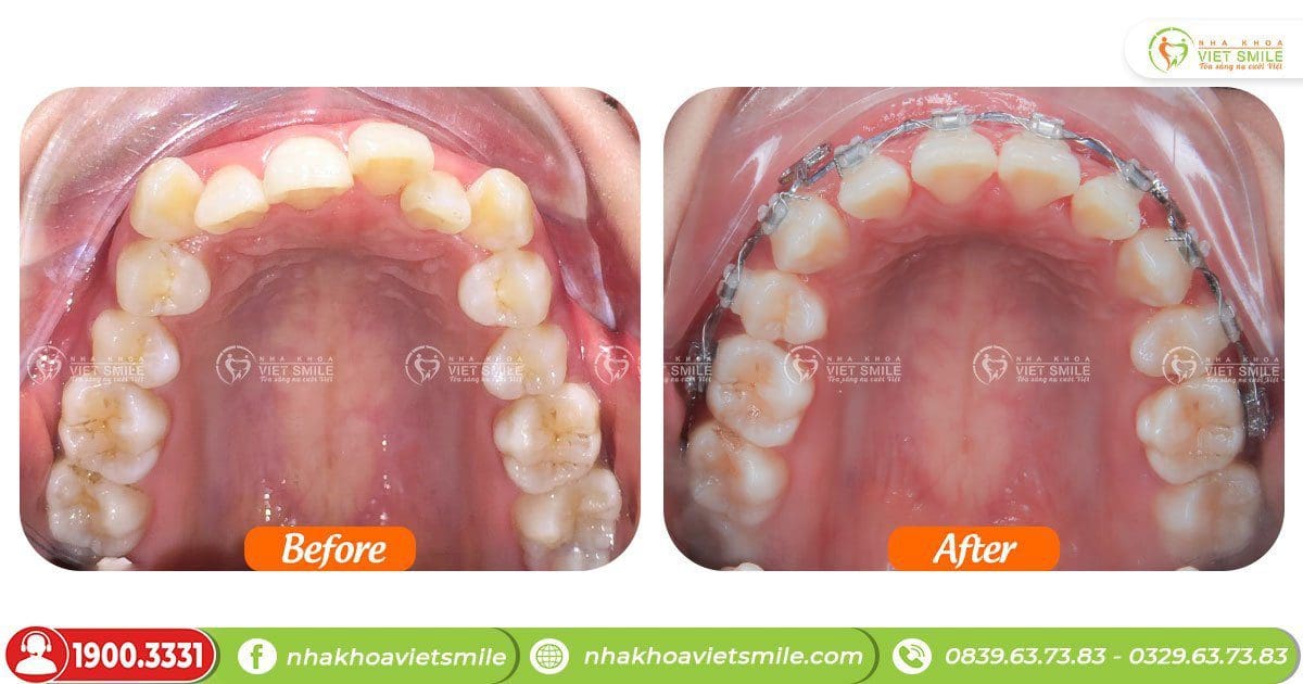 Niềng răng cải thiện chen chúc, cắn sâu cận miệng trong miệng