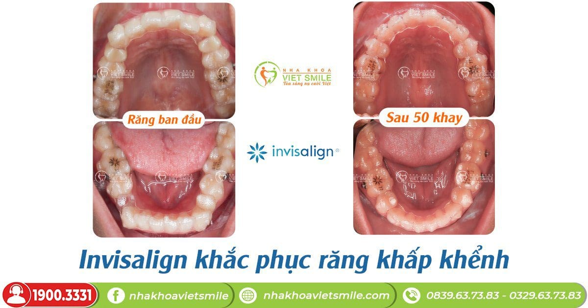 Niềng răng khấp khểnh với invisalign - trong miệng