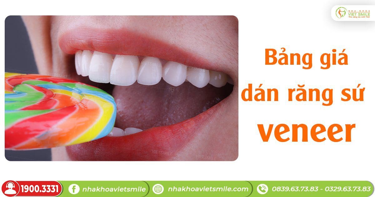 Bảng giá dán răng sứ veneer mới nhất 1 Giá dán răng sứ veneer