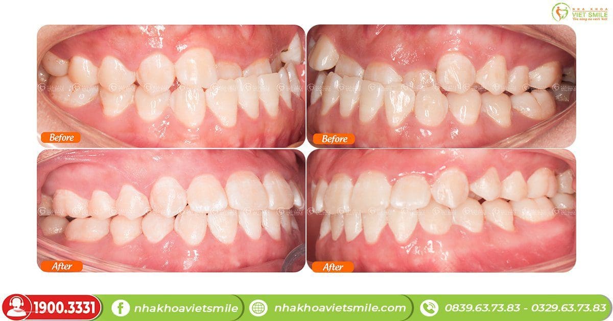 Cải thiện răng móm sau niềng răng