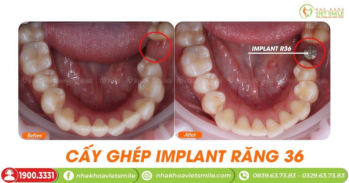 Cay ghep implant
